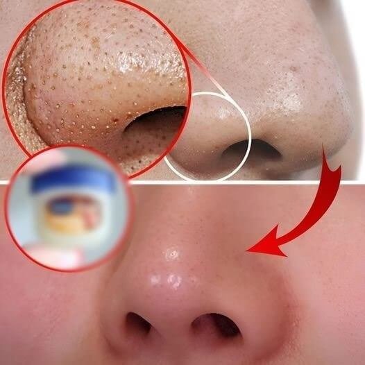 Tips For Squeezing Blackheads On Nose