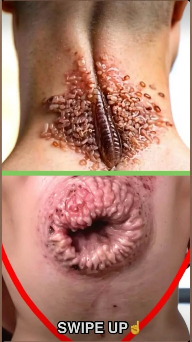 Their acne is severe