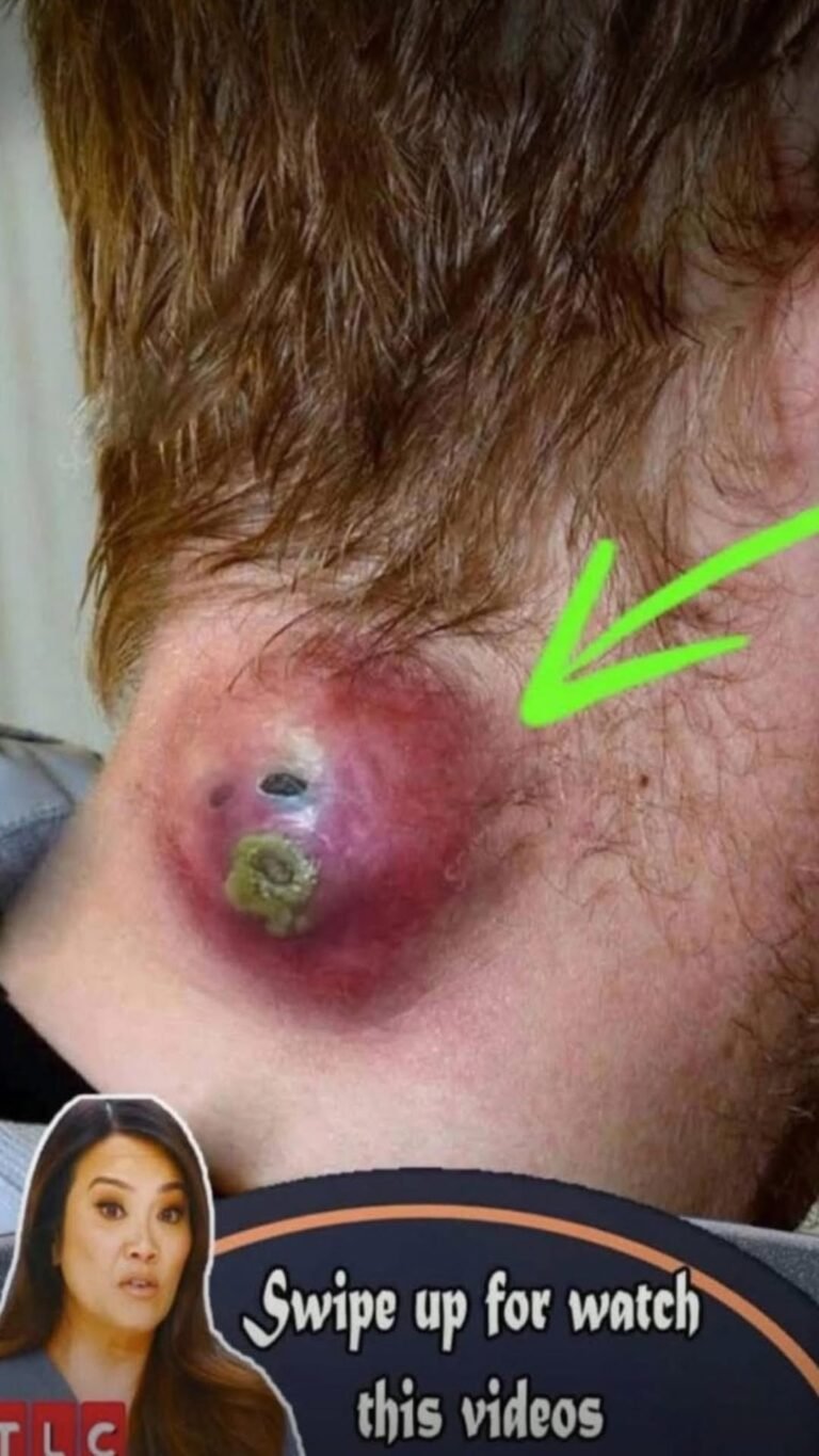 PIMPLES ON THE HEAD THAT YOU SHOULD BE AWARE OF!!!